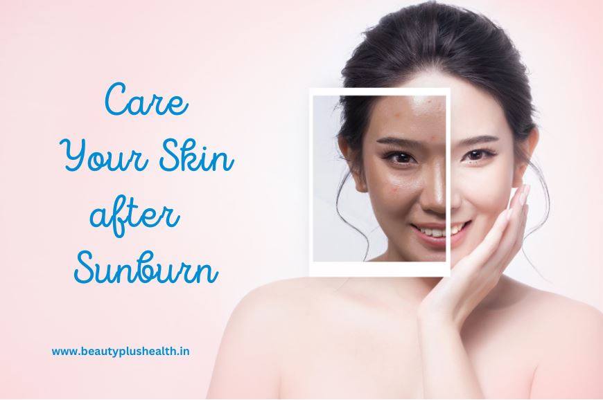 How to Care for Your Skin after a Sunburn